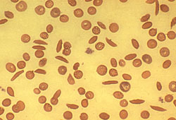 Abb. 13: Rote Blutk&ouml;rperchen, zum Teil sichelf&ouml;rmig verformt. Dieses Bild deutet auf einen heterozygot erkrankten Menschen hin.